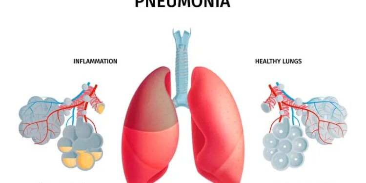RI Targetkan Kematian Balita akibat Pneumonia Turun di 2030 1 Ilustrasi.